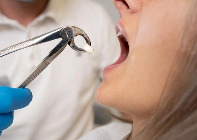 wisdom teeth removal day 7