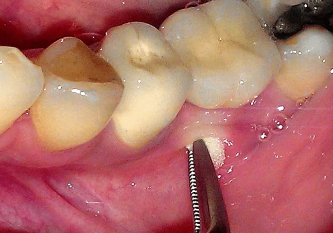 tooth abscess treatment