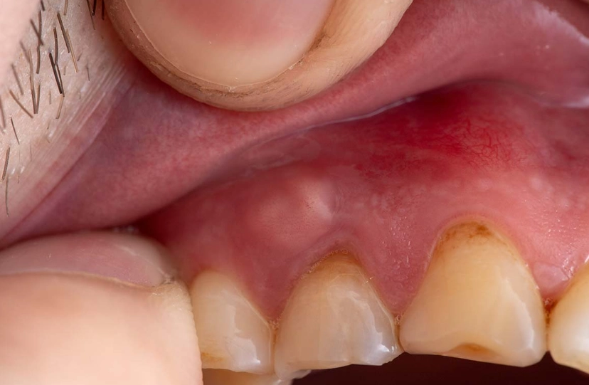 periapical abscess vs periodontal abscess