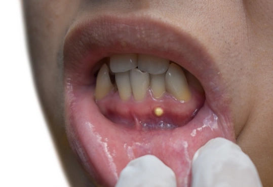 dental abscess symptoms