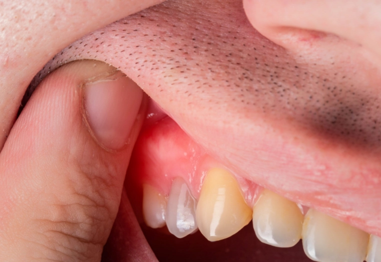 root canal infection antibiotics