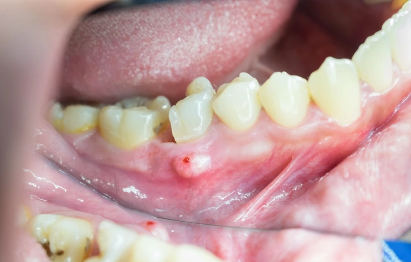 dental infection seriousness