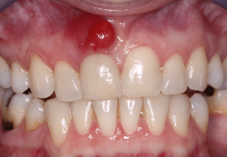 periapical abscess antibiotics