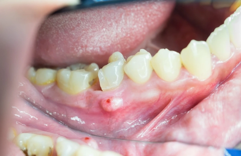 tooth abscess diagnosis code