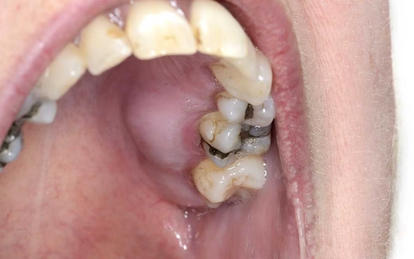 root canal infection antibiotics