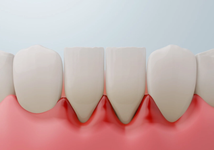 dental abscess types