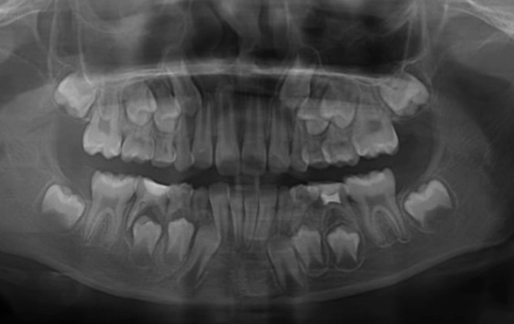 gum boil treatment gum boil treatment