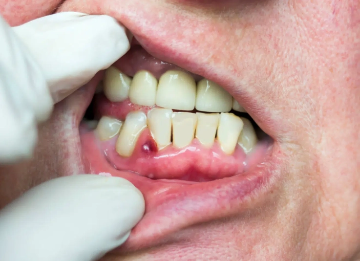 tooth abscess treatment