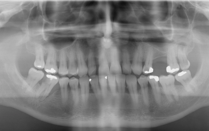 dental abscess symptoms