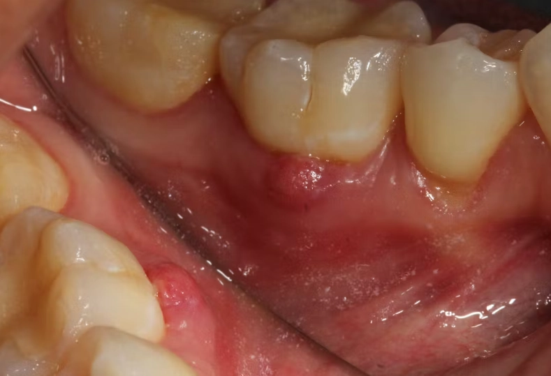dental sinus tract dental sinus tract
