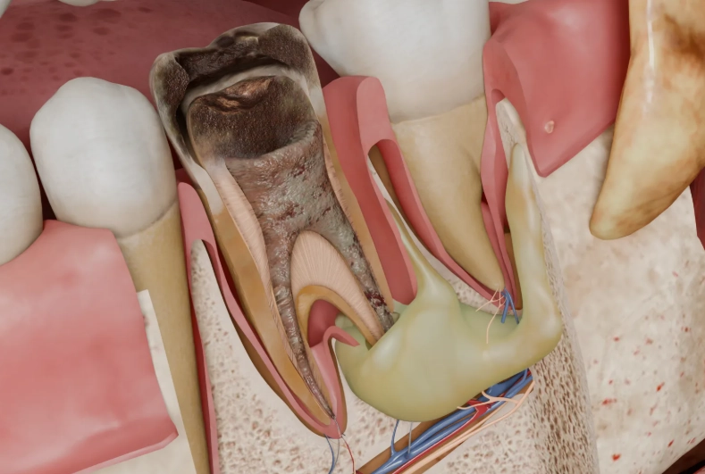 periapical abscess symptoms