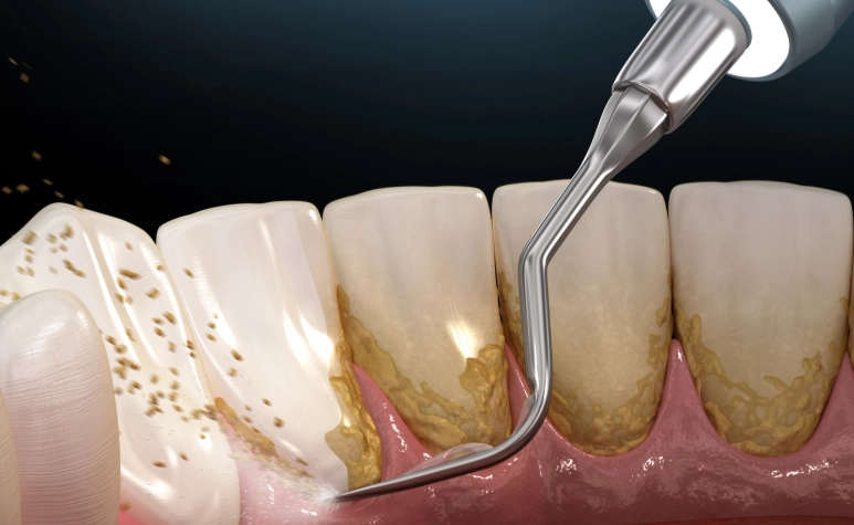 scaling and root planing