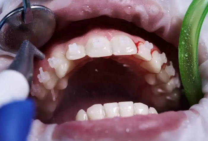 gum recovery after deep cleaning