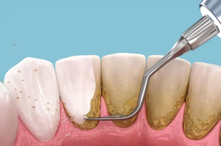 scaling and root planing reviews