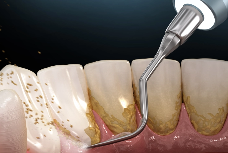 gum recession treatment
