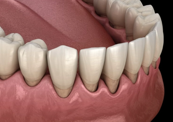 deep cleaning for gum recession