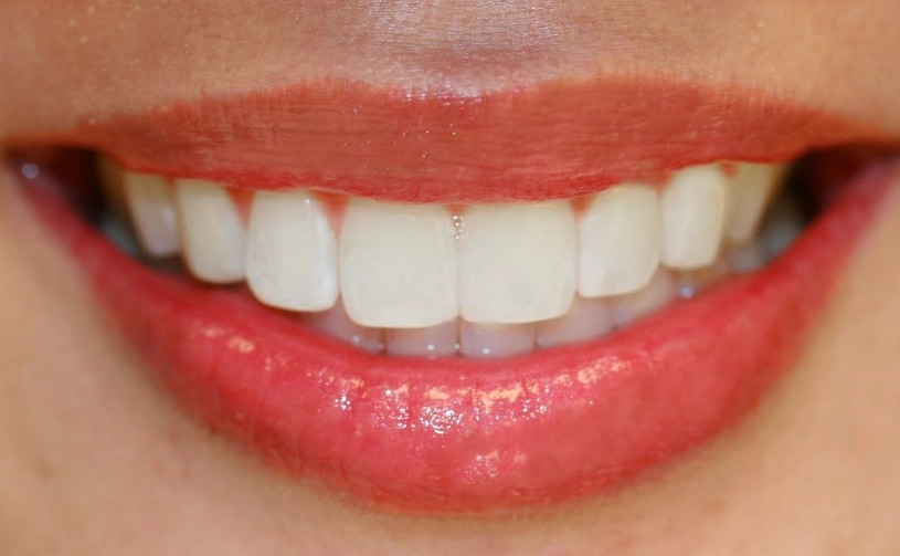 fast teeth whitening at home