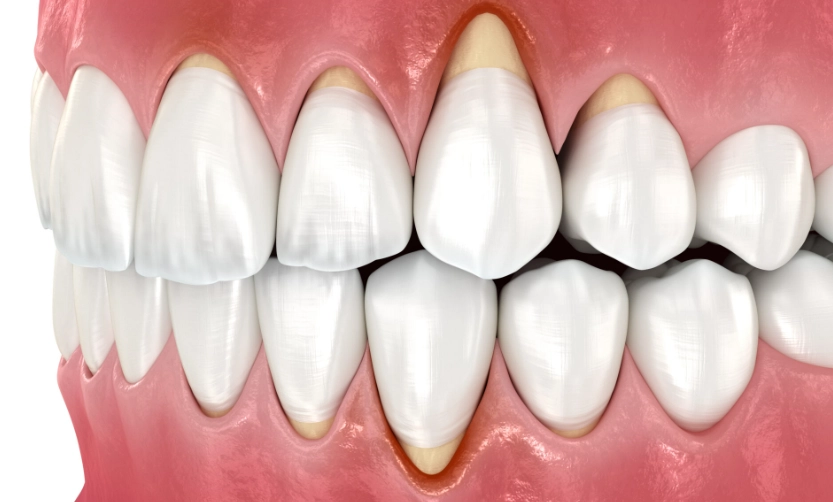 gum disease treatment