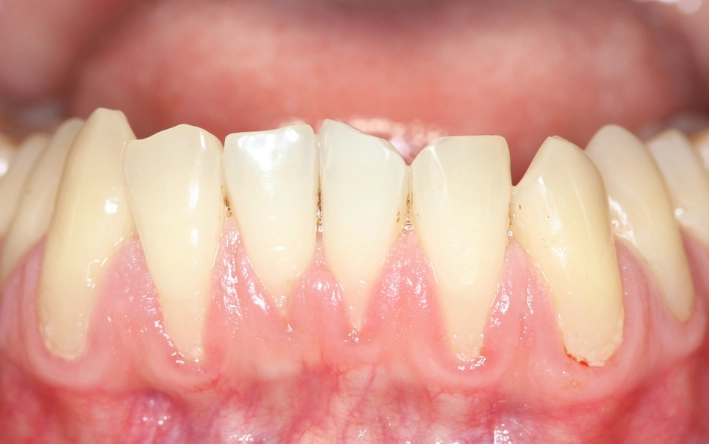 deep cleaning for gum recession