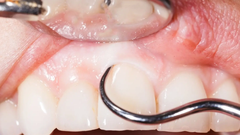 deep gum cleaning pain