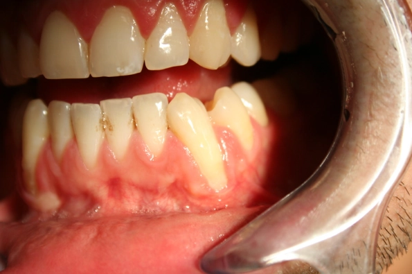 gum recession treatment