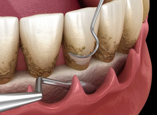 deep teeth cleaning reviews