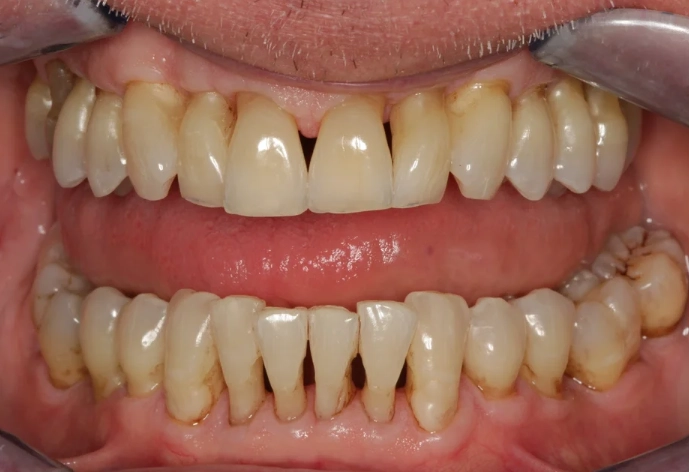 scaling and root planing