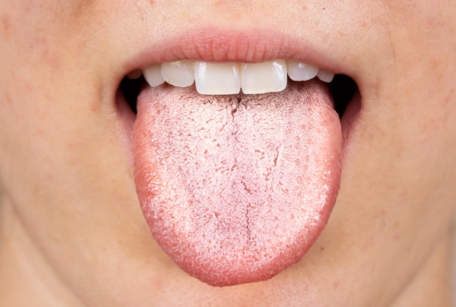how to get rid of oral thrush