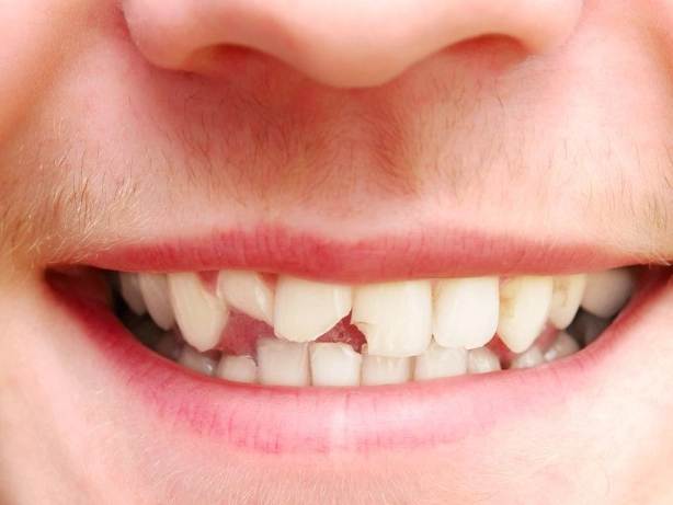 calcium deficiency teeth symptoms