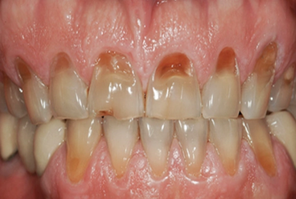 teeth grinding damage