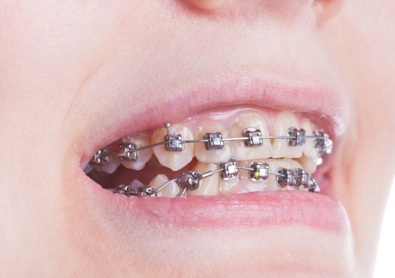 fix underbite fix underbite