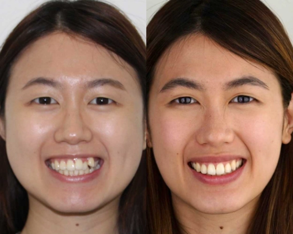 invisible aligners before and after