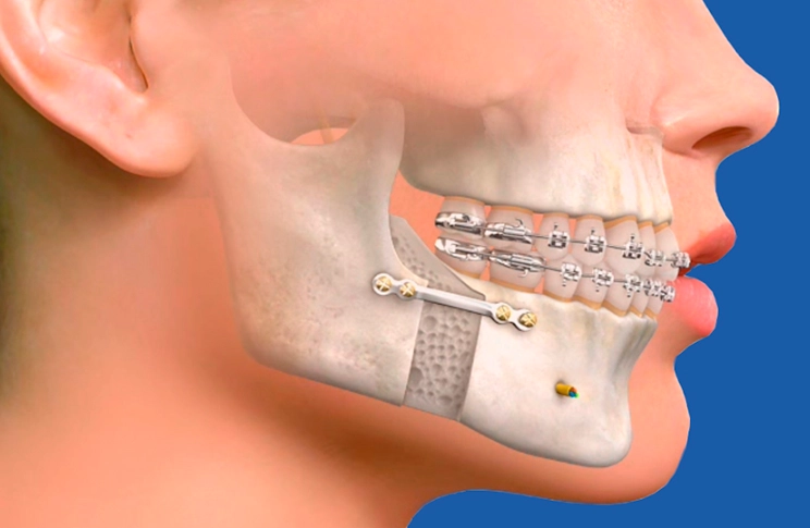 jaw surgery cost