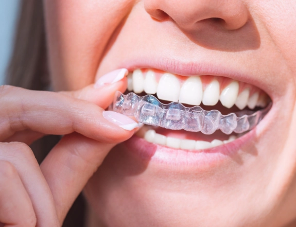 invisible aligners before and after