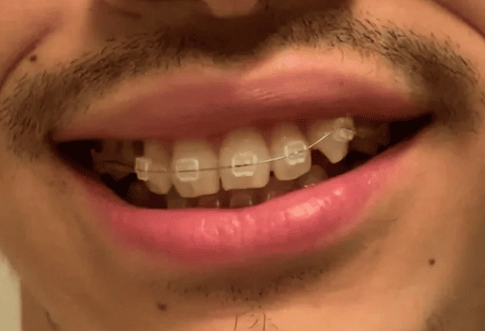 fix underbite fix underbite
