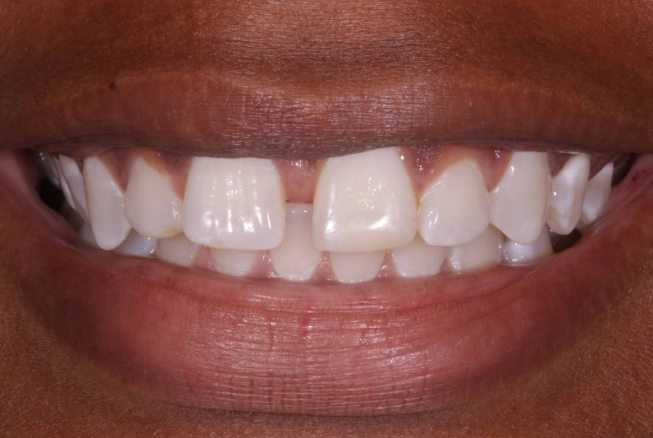 teeth gap treatment