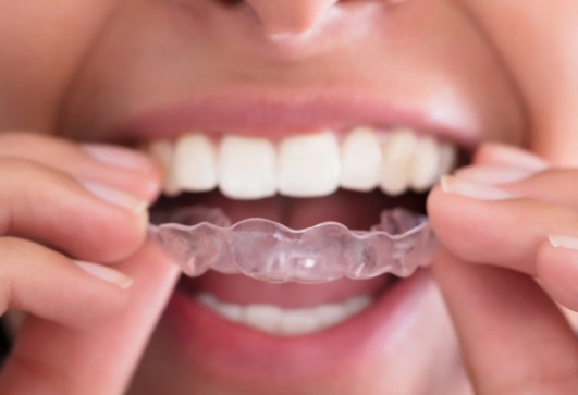 braces before and after