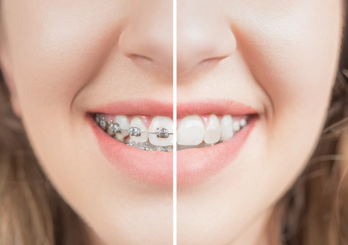 braces before and after