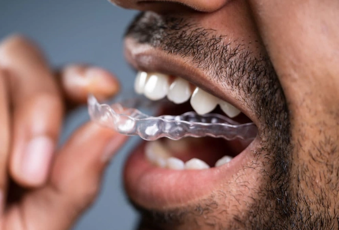 how long to wear retainers