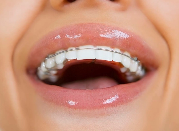 how long to wear retainers