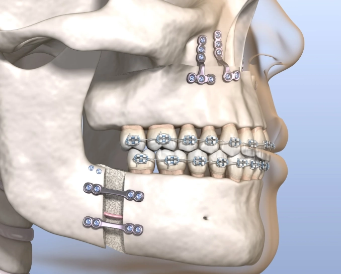 orthodontic surgery