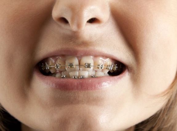 underbite treatment underbite treatment