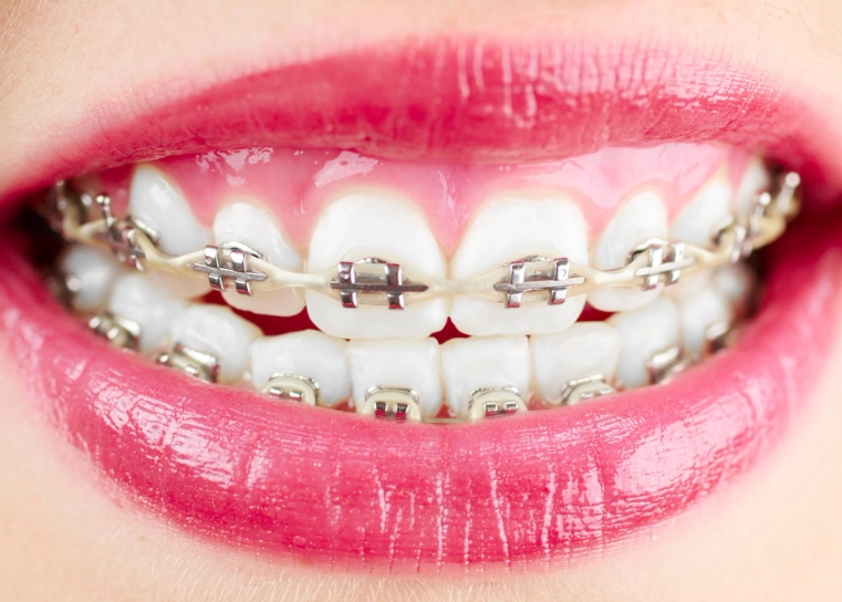 metal braces vs invisalign metal braces vs invisalign