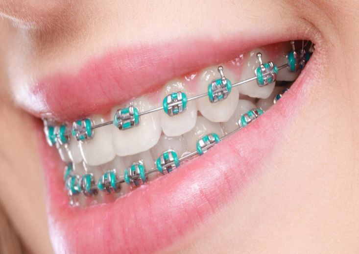 metal braces