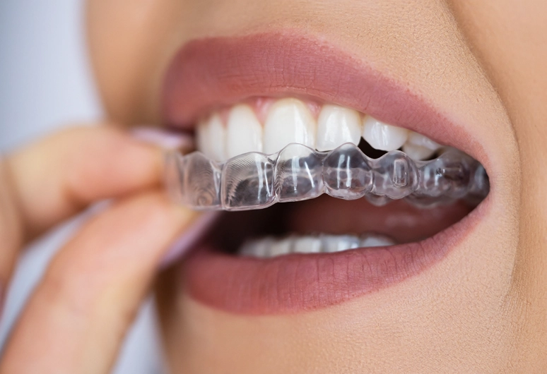 adult braces
