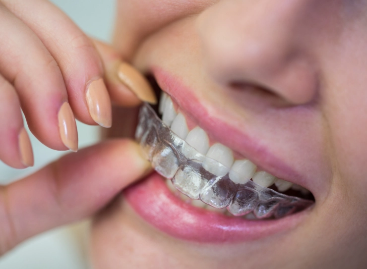 teeth straightening options