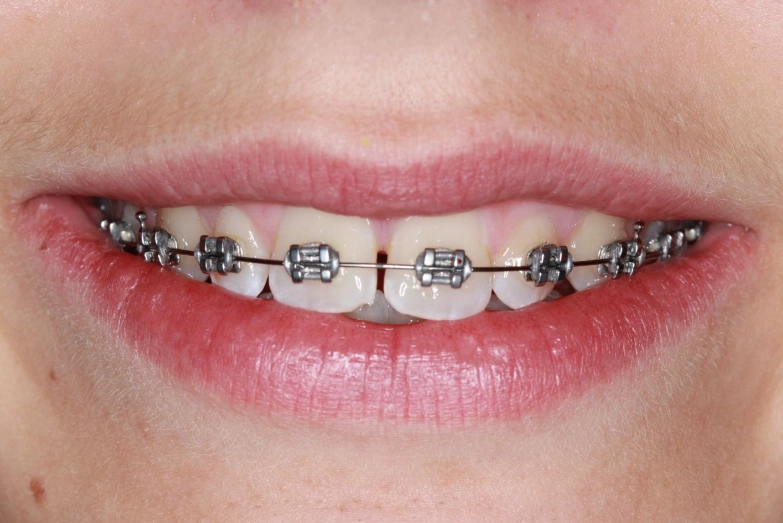 how to clean metal braces how to clean metal braces