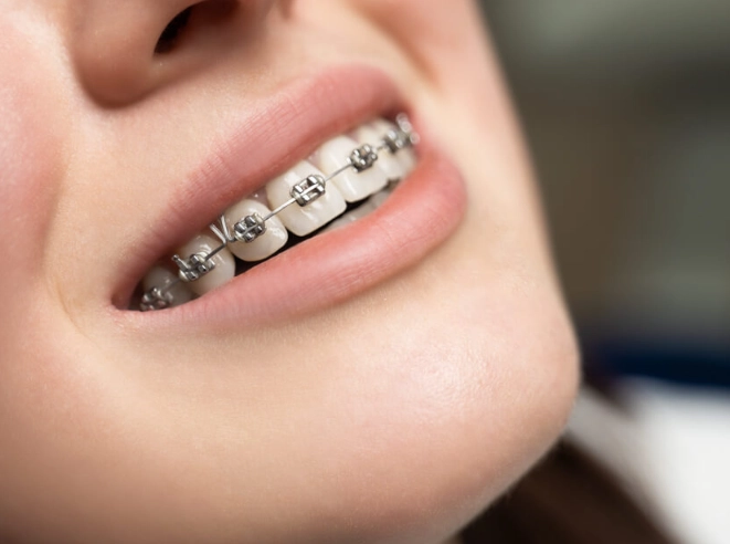 orthodontics for adults