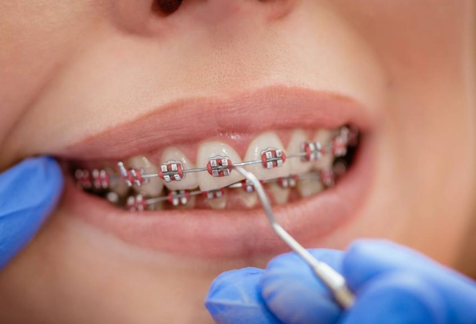 braces treatment steps