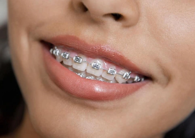 metal braces cost metal braces cost
